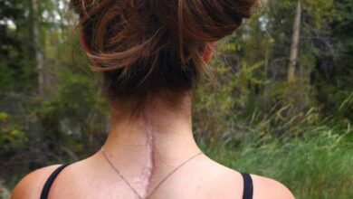 Médicos le unen la cabeza al cuerpo a una mujer que casi queda decapitada haciendo deporte