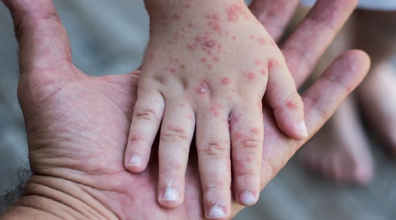 Estados Unidos supera mil casos de sarampión en 2025