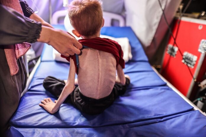 Un hospital de Gaza asegura que 21 niños murieron de hambre o desnutrición