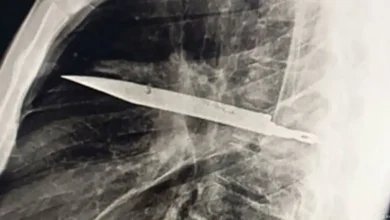 Revelan el caso de un hombre que sobrevivió ocho años con una hoja de cuchillo incrustada en el tórax