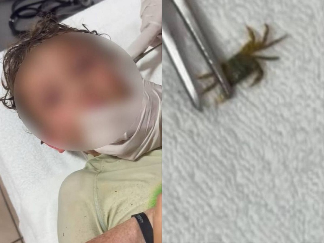 Cirujanos extraen un cangrejo vivo del oído de un niño en México