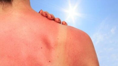 Quemaduras solares: seis consejos para aliviar el dolor y cuidar tu piel