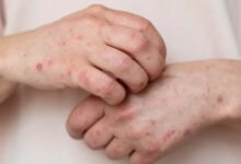 Israel: Brote de sarampión deja nueve niños muertos por baja vacunación