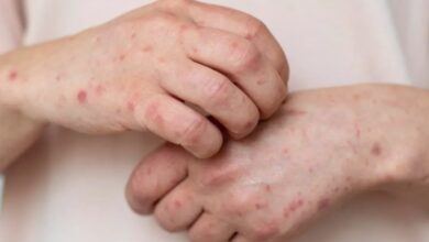 Israel: Brote de sarampión deja nueve niños muertos por baja vacunación