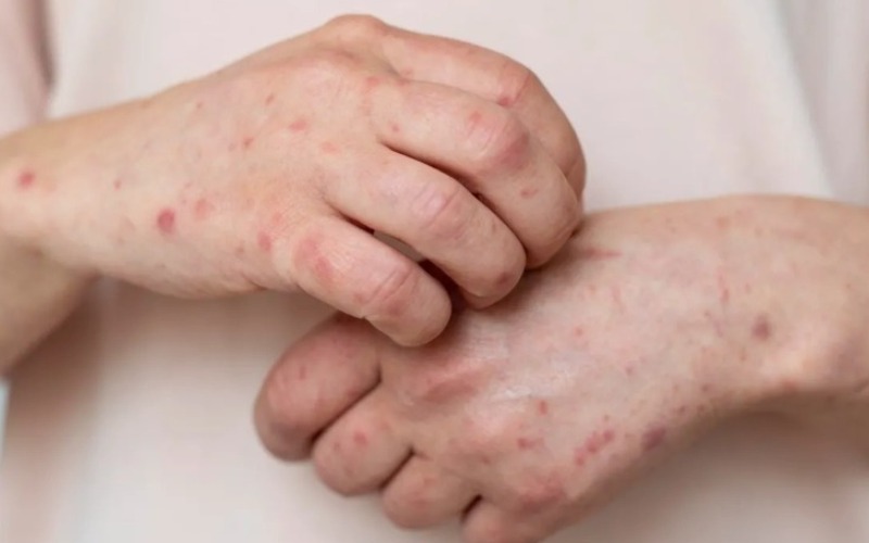 Israel: Brote de sarampión deja nueve niños muertos por baja vacunación