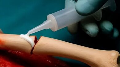 Crean un pegamento para huesos que promete reparar fracturas en tiempo récord