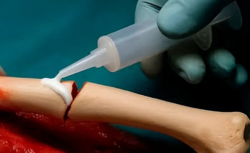 Crean un pegamento para huesos que promete reparar fracturas en tiempo récord