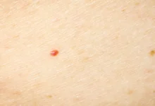 Qué son los lunares rojos que aparecen en el cuerpo y cuándo hay que preocuparse