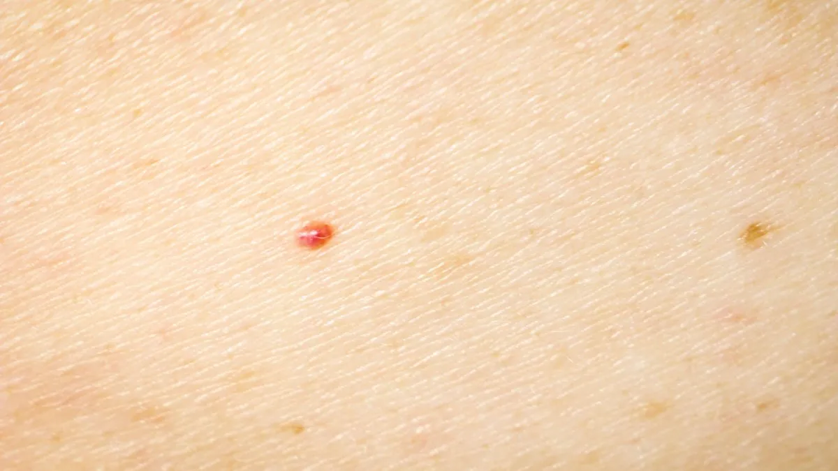 Qué son los lunares rojos que aparecen en el cuerpo y cuándo hay que preocuparse