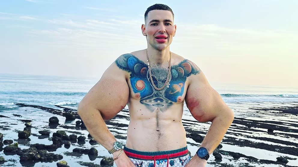 El "Popeye ruso" enfrenta la amputación doble de brazos tras inyectarse vaselina y Synthol