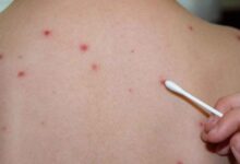 MSF alerta sobre un aumento crítico y acelerado de sarampión en Darfur, Sudán