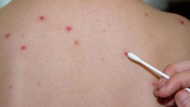 MSF alerta sobre un aumento crítico y acelerado de sarampión en Darfur, Sudán