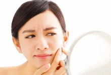 Más allá de la adolescencia: El impacto emocional y físico del acné adulto en las mujeres