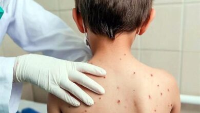 Alerta sanitaria en Perú por riesgo de brotes de sarampión y poliomielitis