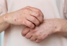 Colombia confirma tres casos de sarampión y refuerza protocolos de vigilancia