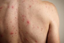 Colombia confirma primer caso importado de sarampión procedente de México