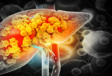 Guía para identificar el daño hepático antes de que sea tarde