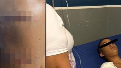 Adolescente sufre grave lesión en un brazo tras ser embestido por una lancha en Falcón