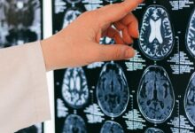 Vacuna contra la gripe de alta dosis reduciría el riesgo de Alzheimer en un 55%, según estudio