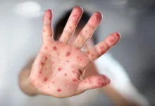 Ecuador confirma el primer caso de la nueva variante de viruela del mono