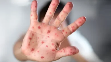 Ecuador confirma el primer caso de la nueva variante de viruela del mono