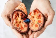 ¿Sufres de cálculos? Expertos advierten sobre las altas probabilidades de volver a padecerlos