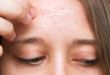 El Espejo del Alma: Por qué tu estrés se convierte en acné o psoriasis