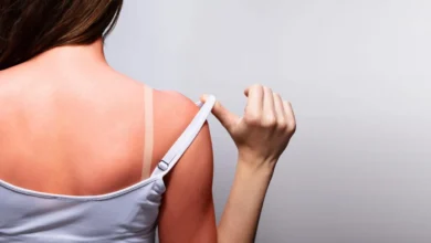 ¿Cómo tratar una quemadura solar? Consejos de expertos para aliviar la piel