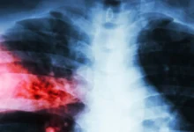 Clave contra cáncer de pulmón podría estar en inesperado «interruptor metabólico»