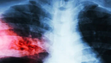 Clave contra cáncer de pulmón podría estar en inesperado «interruptor metabólico»