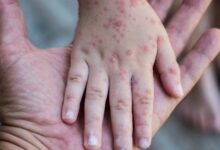 Científicos intentaron ingresar 113 viales con virus de viruela del mono a EE.UU.