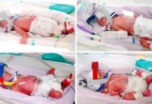 Mujer da a luz a cuatrillizas idénticas en Australia en un caso médico de concepción natural