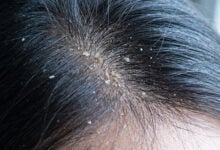 Guía de Cuidado: Caspa seca vs. caspa grasa: cómo identificarlas y tratar el cuero cabelludo correctamente
