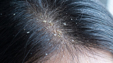 Guía de Cuidado: Caspa seca vs. caspa grasa: cómo identificarlas y tratar el cuero cabelludo correctamente