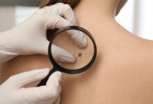 Cuba desarrolla tratamiento para el cáncer de piel