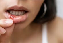 Aprenda cómo prevenir y tratar las molestas úlceras bucales de forma rápida