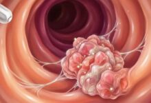El 20% de los casos de cáncer colorrectal en jóvenes corresponde a menores de 55 años