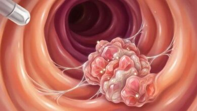 El 20% de los casos de cáncer colorrectal en jóvenes corresponde a menores de 55 años